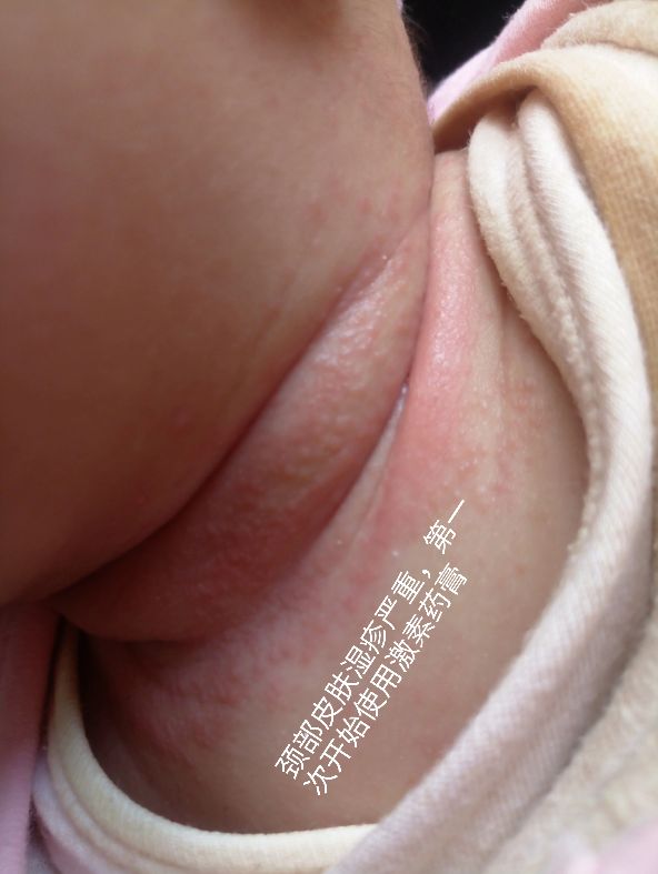 家有湿疹娃是什么体验,家有宝宝必会急救知识