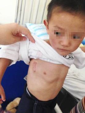 先心病手术侧切好还是开胸好,先心病右腋下切口缺点