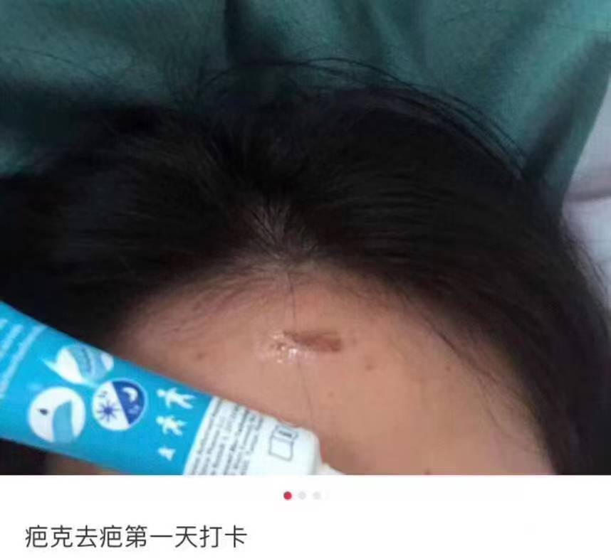 你用过最好的祛疤方法,小红书推荐祛疤真的有效吗