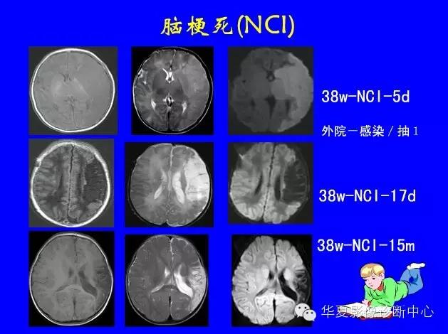 新生儿颅脑mri,新生儿颅脑mr报告模板