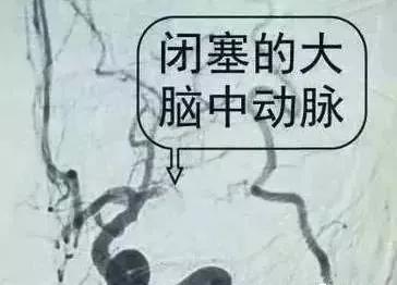 脚上暗藏化血栓开关,脚部静脉血栓的最快消除方法