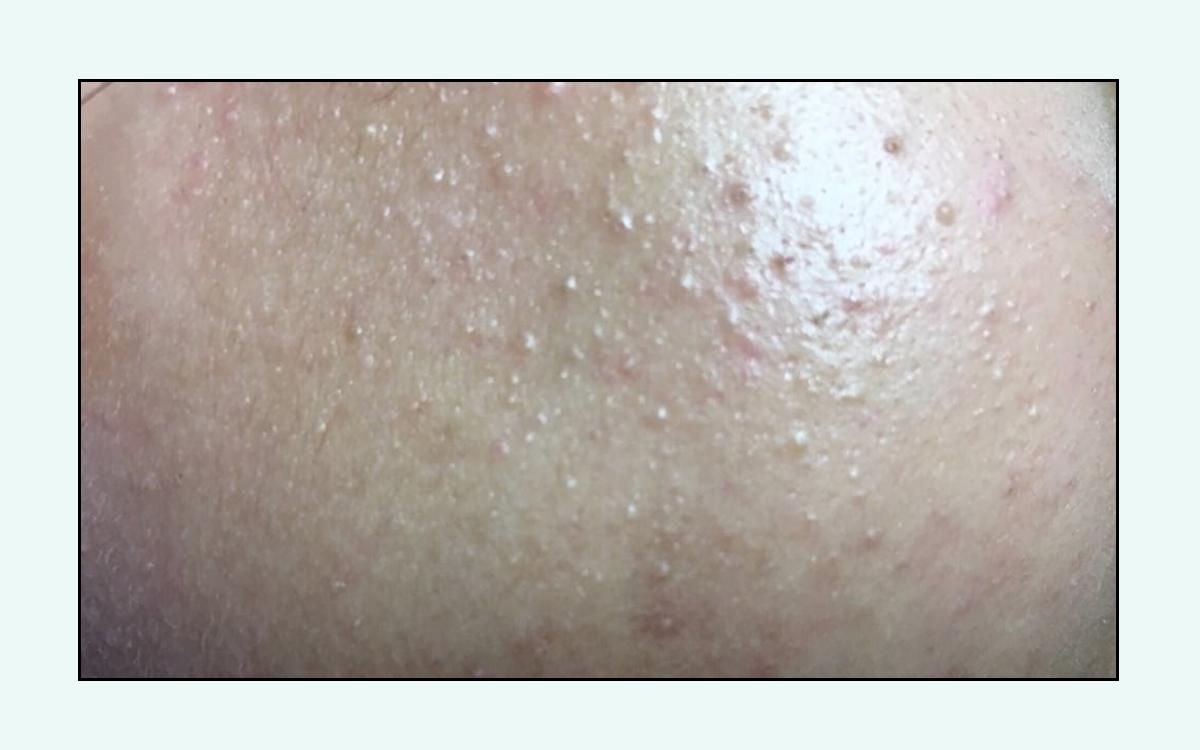 脸上的红疙瘩痒,脸上的红疙瘩用什么药膏