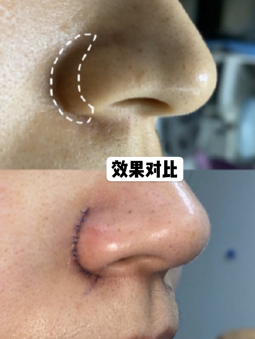 鼻翼缩小可以单独做吗,鼻翼缩小可以内切吗