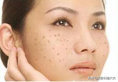 一脸褐斑怎么办,得了紫斑严重吗
