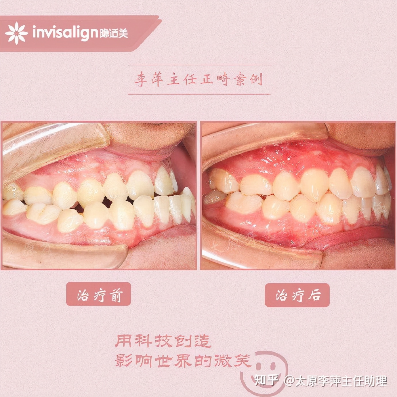 太原牙齿矫正靠谱吗,太原成人隐形牙套牙齿不齐