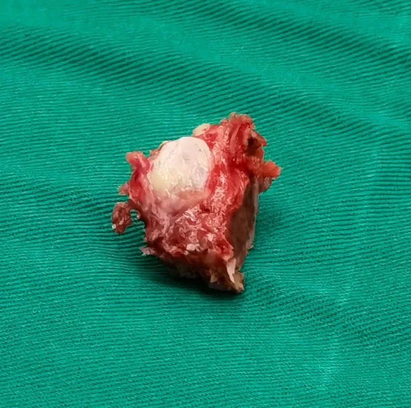 北京积水潭机械臂手术,积水潭机器人微创