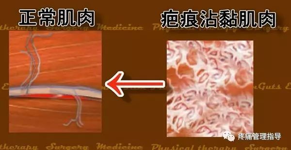 网球肘能自我恢复吗,网球肘病因的解剖学研究