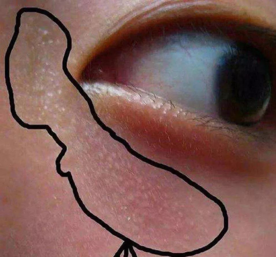 眼部的脂肪粒要怎样治,眼部脂肪粒挑不破