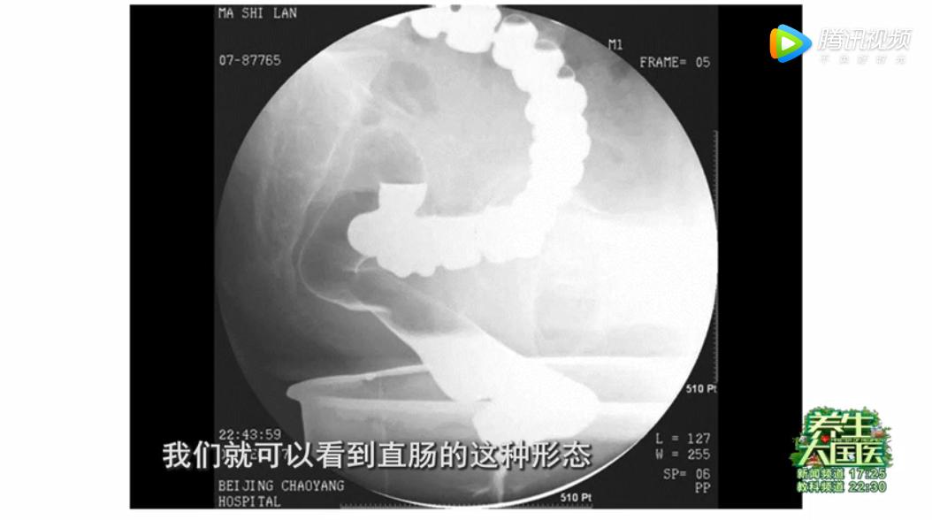 肛门坠胀排除痔疮还有什么原因,痔疮手术后肛门坠胀有便意拉不出