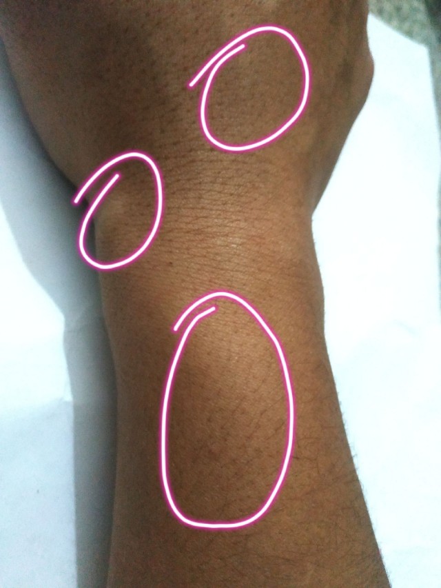 手受伤后，附近血管感觉有些堵塞，摸起来有个小包，这是怎么回事