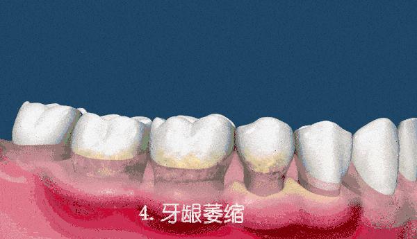 牙龈萎缩牙齿松动有办法补救吗？这个方法可以试一试