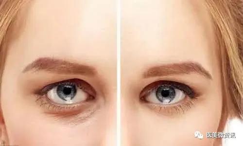 眼周祛皱,眼周祛皱什么项目好