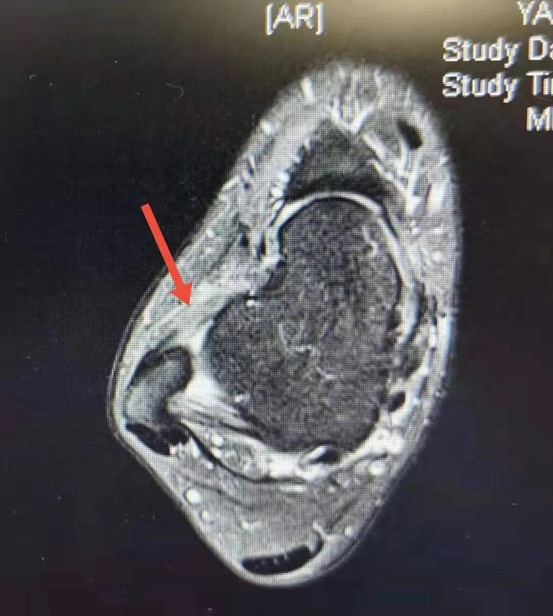外踝扭伤怎么判断韧带是否恢复,外踝韧带损伤之后能彻底恢复吗