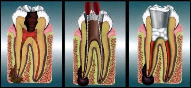 根管治疗后的牙冠需要多少钱,根管治疗不戴冠能用几年