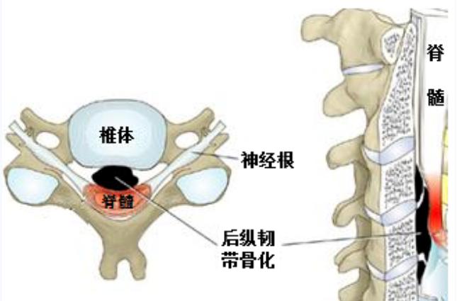 检查发现颈椎错位怎么办,后纵韧带骨化是脊髓型颈椎病吗