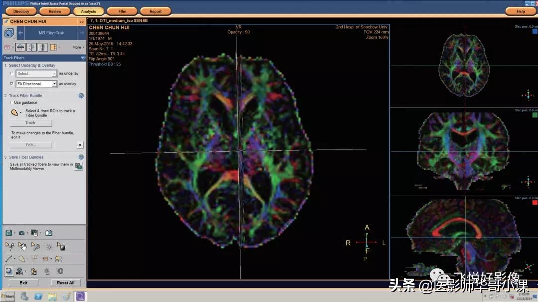 飞利浦磁共振波谱成像扫描技术,飞利浦磁共振纵隔扫描技术