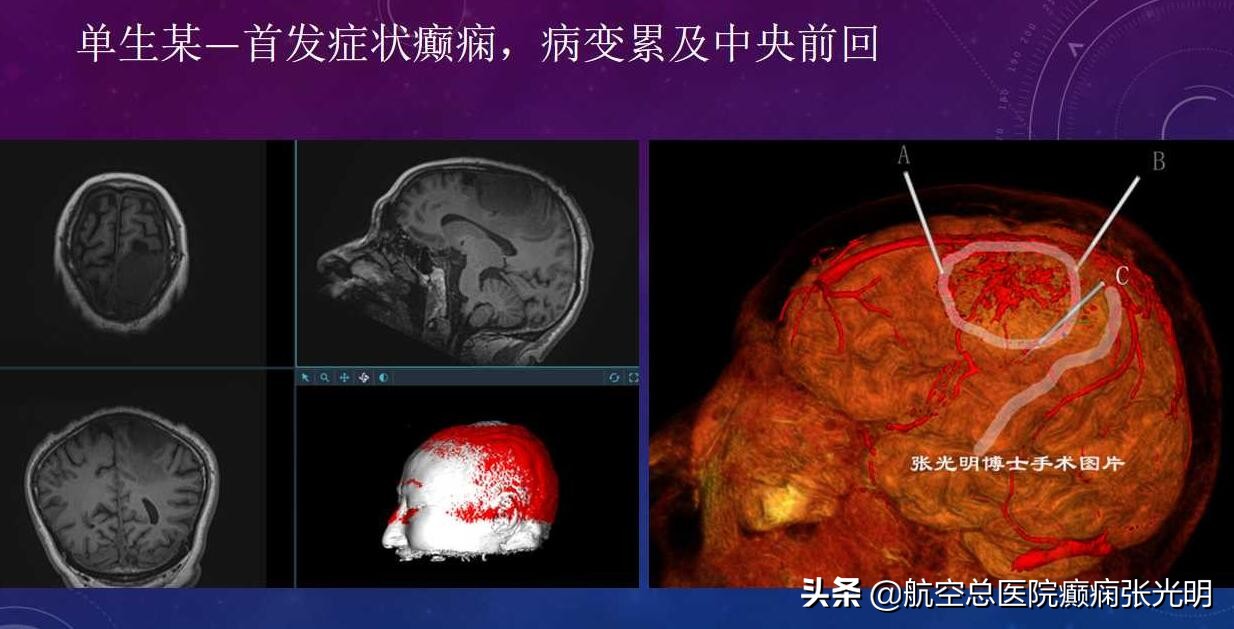 张光明左颞叶癫痫手术成功率,张光明谈治疗癫痫的方法有哪些