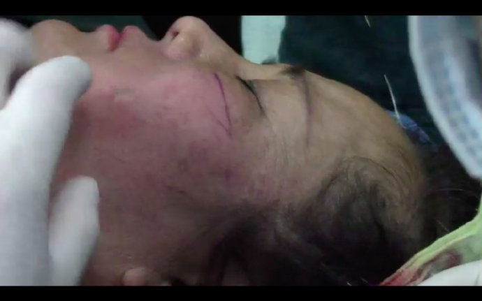 线雕三个月摸起来仍凹凸不平,面部线雕后凹凸不平如何处理