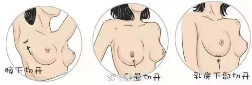 隆胸选择光面还是毛面,隆胸选高凸还是中凸