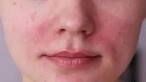 面部敏感发红发烫是什么原因,老年人面部发红是什么原因
