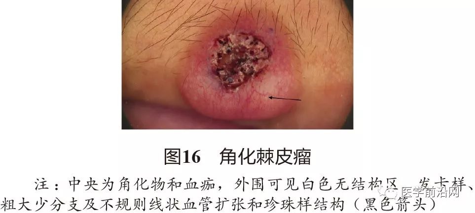 面部常见皮肤病皮肤镜诊断专家共识全文发布