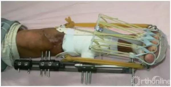 外固定支架训练方法,外固定支架拆除后怎么护理