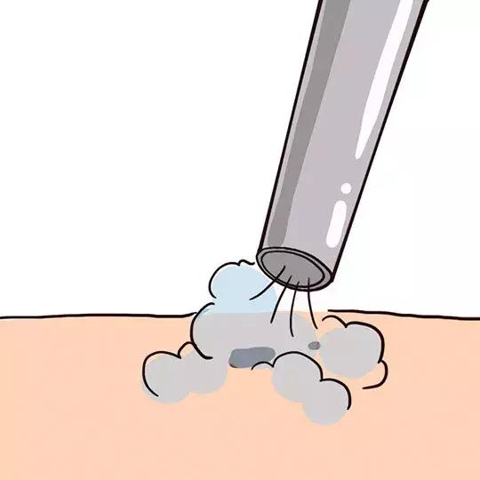 激光祛痣怎么好得快不留疤,激光祛痣亲身经历和感受