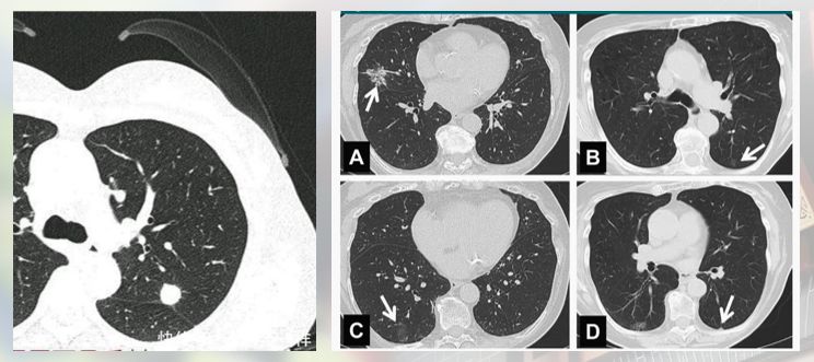 华西廖正银教授治肺结节,华西医院肺癌专家唐小军