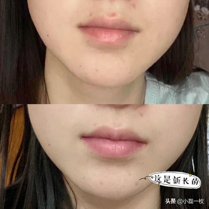 真正有效的祛痘印产品推荐,有什么很好的祛痘印产品