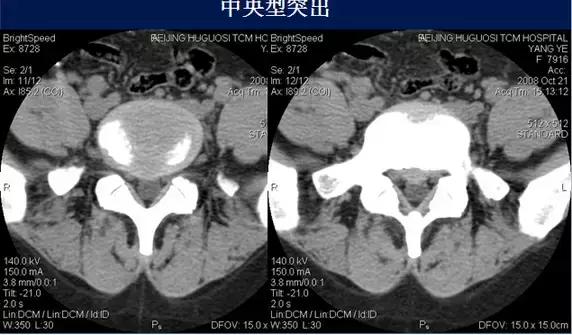 腰椎退行性变腰椎间盘轻度突出,椎间盘突出并膨出继发椎管狭窄
