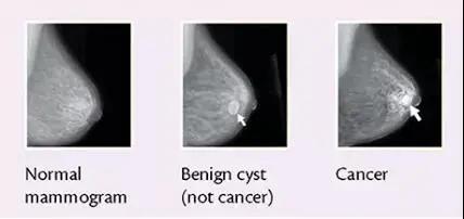 说说早期癌能不能彻底治愈,幸福癌治愈案例