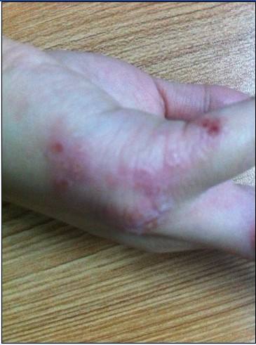 脸上湿疹一直反反复复,面部皮炎湿疹反反复复