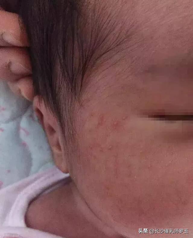 40天宝宝身上起小红点,宝宝身上起小红点用什么药膏
