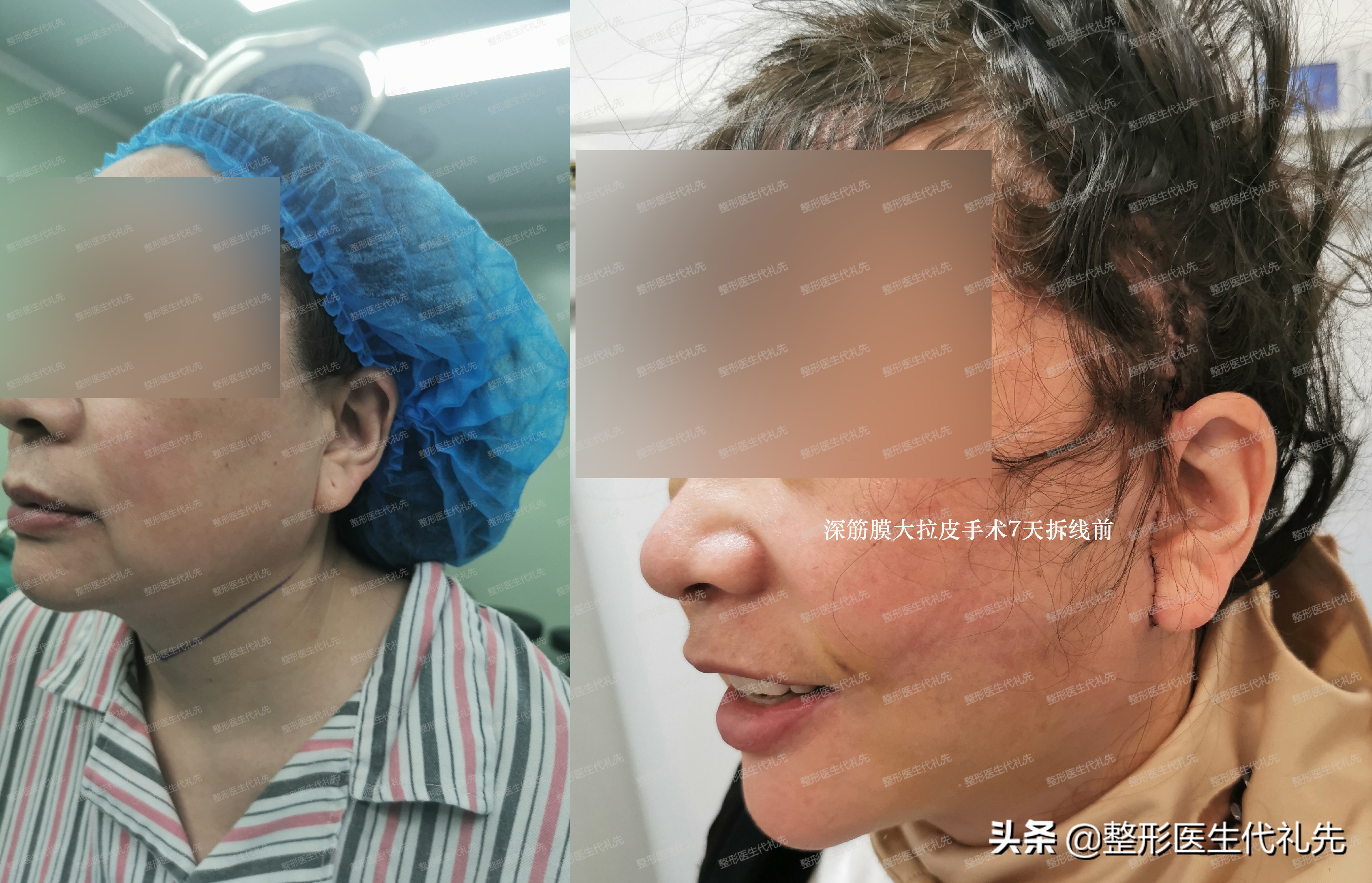 面部提升手术的最佳方法,小切口面部提升手术面部变化