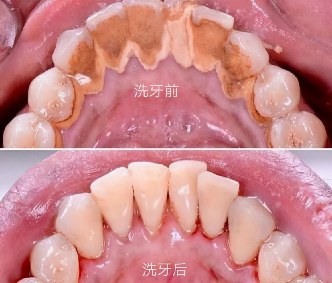 牙齿太黄刷牙总是刷不干净怎么办,天天刷牙还是牙黄口臭是怎么回事