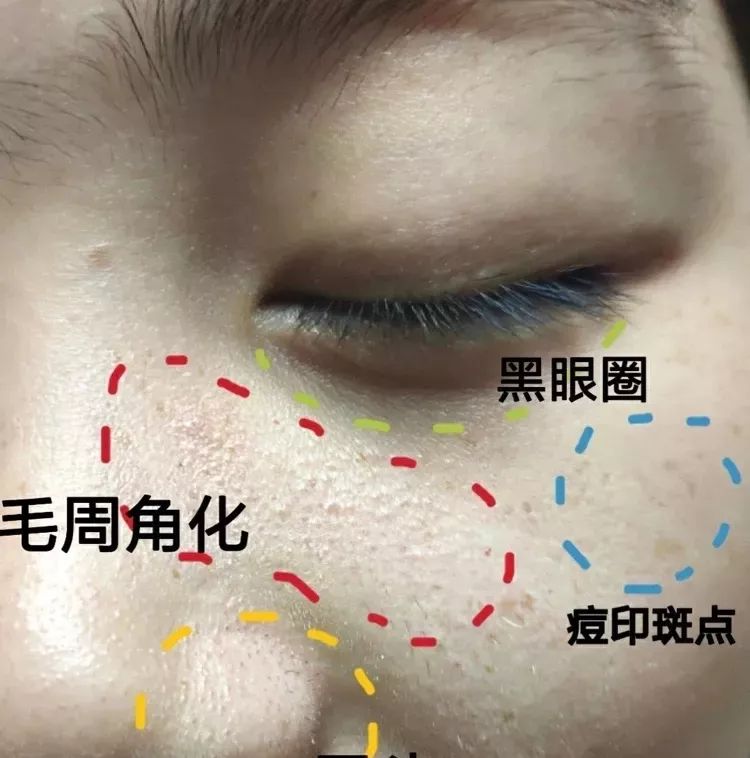 下巴挤出小米粒样的东西,下巴闭口挤出来的东西臭