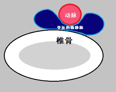 动脉压迫静脉什么原因,下肢动脉闭塞会引起小腿肿吗