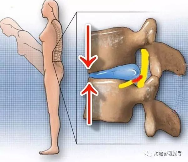 72岁老人腰疼还有骨刺该怎么治疗,老年人骨刺疼痛怎么治疗