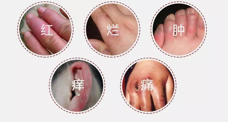 寒潮来袭怎样才能躲开冻疮,天气回暖怎么预防冻疮