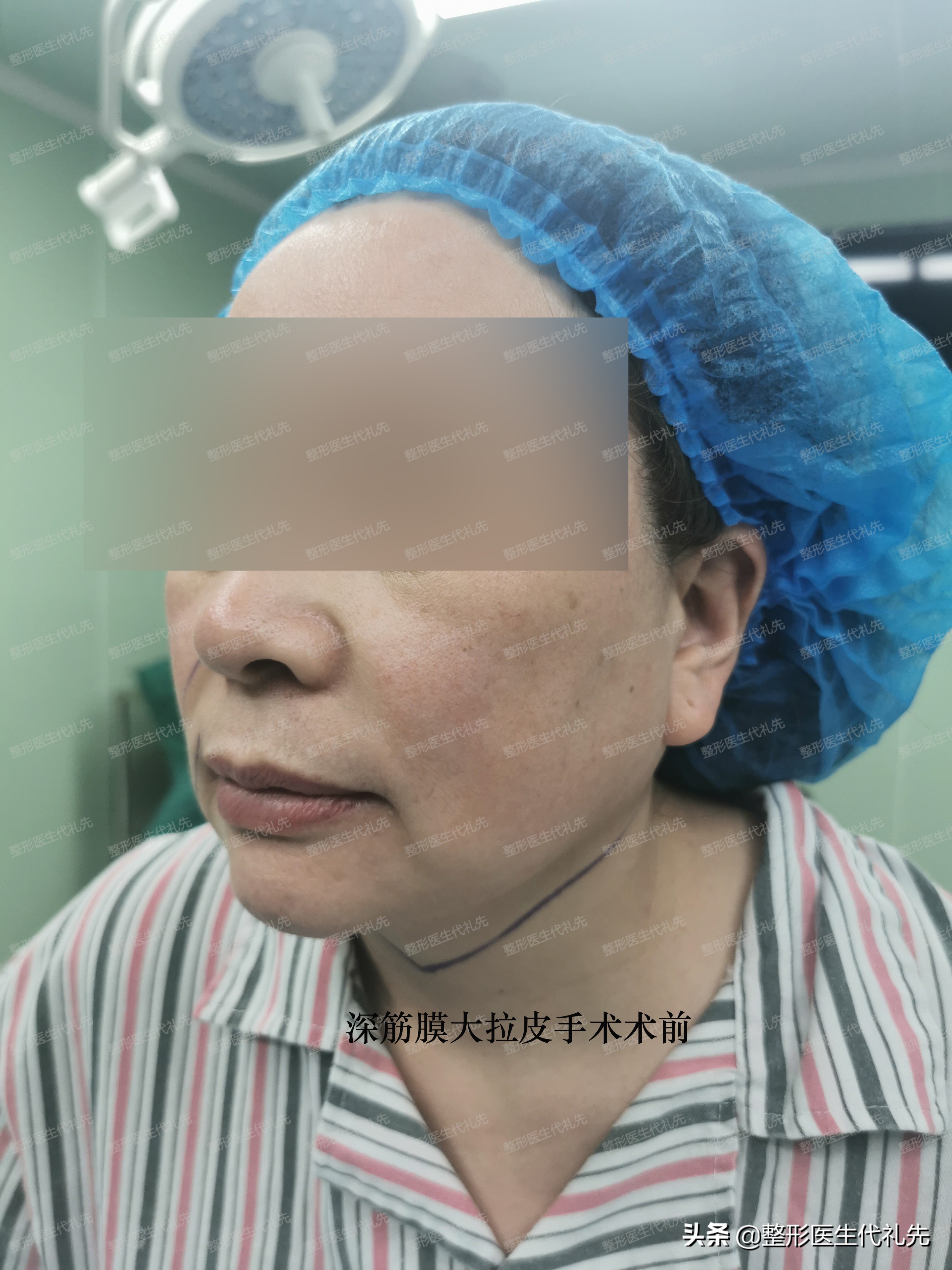 面部提升手术的最佳方法,小切口面部提升手术面部变化