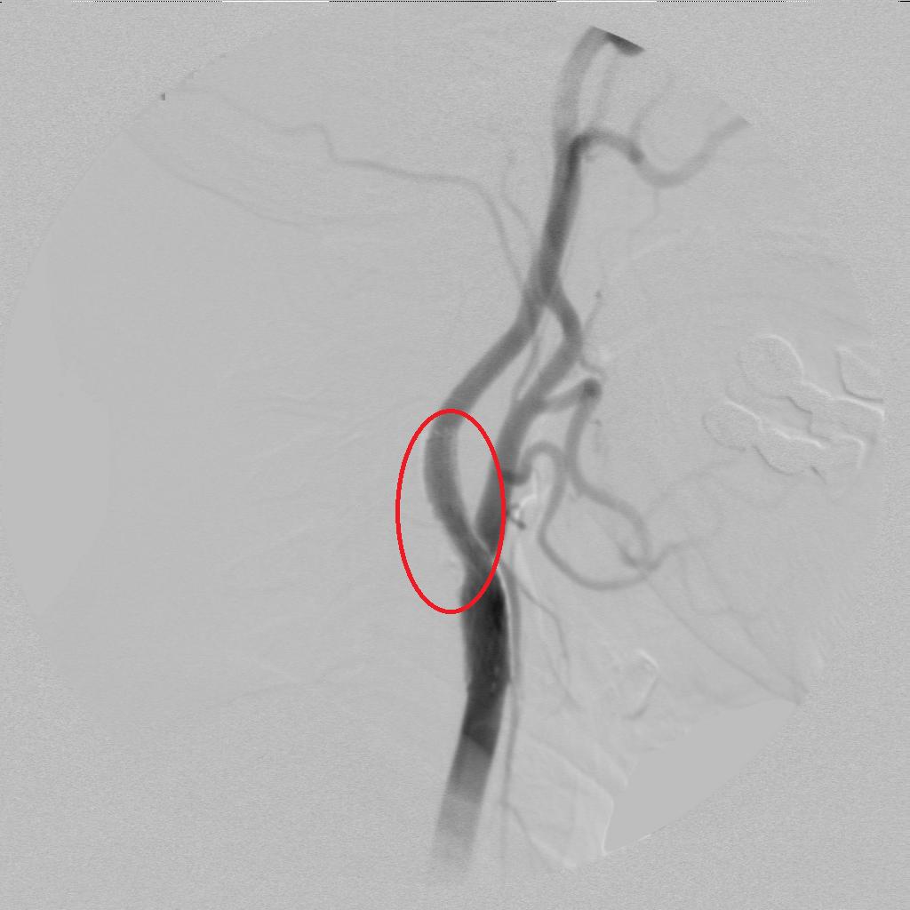 脑中风治疗一般几个疗程,一分钟识别脑卒中正确的做法