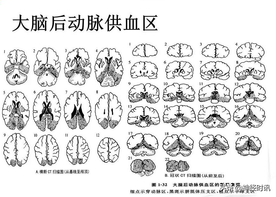 脑动脉解剖学讲解,基底节区脑血管解剖