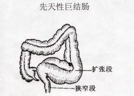 腹腔镜下全结肠根治性切除术,先天性巨结肠腹腔镜手术