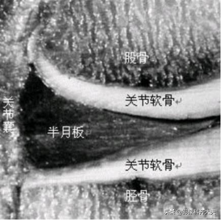 膝关节半月板损伤的磁共振,膝关节半月板病变的mri诊断与鉴别