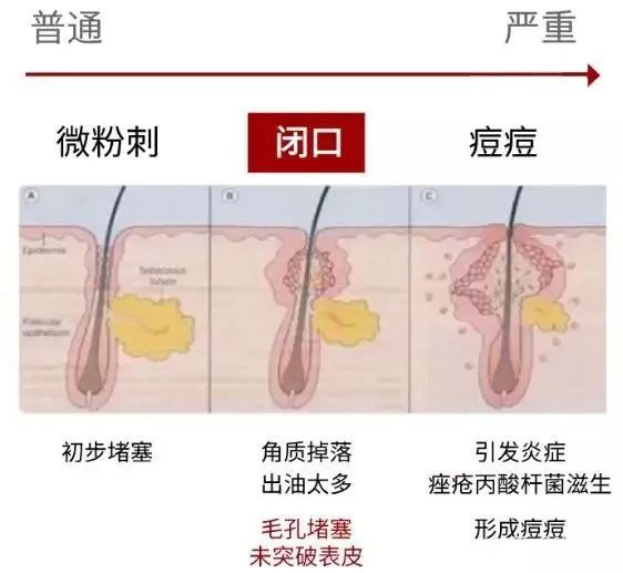 粉刺黑头真的没办法治疗吗,黑头粉刺不要清理会怎样