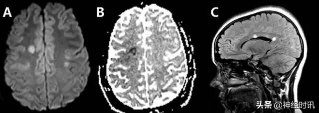 脑卒中的快速识别ppt,脑卒中神经影像学实例解析