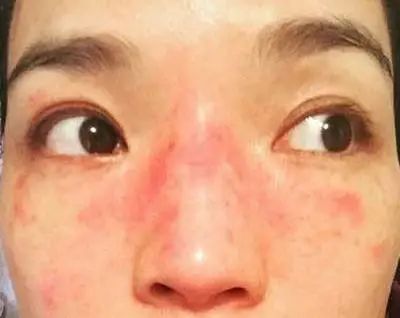 脸一换季就过敏怎么办,换季脸部过敏最快的补救方法