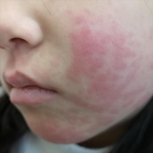 敷完面膜为啥长出来一个痘,敷了面膜皮肤还是掉皮