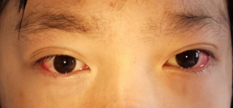 斜视手术吓人吗,斜视手术危险么