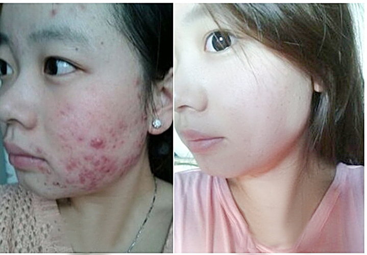 青春痘怎样才能快速消除小妙招,青春痘如何快速消除盘点祛痘招数